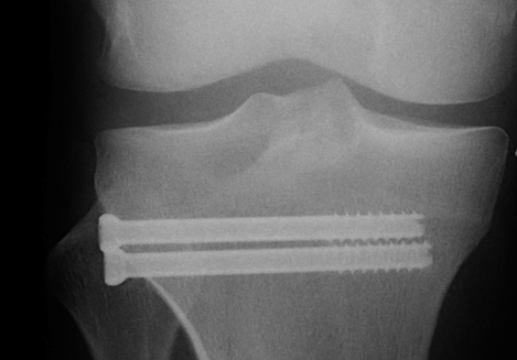 Tibial Plateau Schatzker 1 Percutaneous Screws